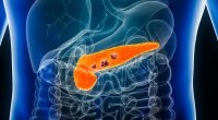 Pancreatic cancer