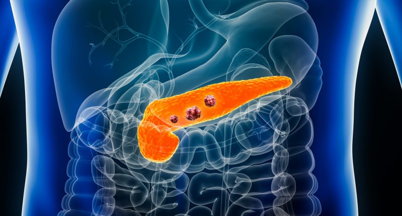 Pancreatic cancer