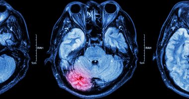 MRI of brain injury